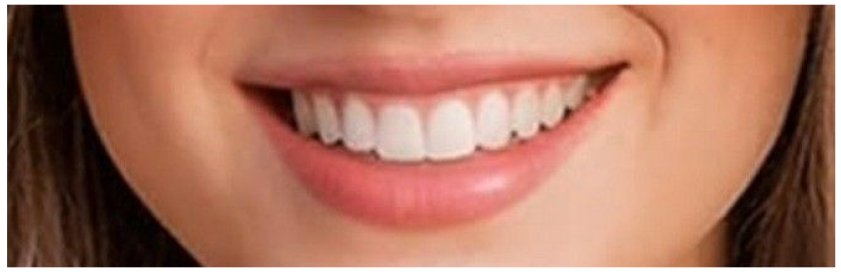 Hollywood Smile au Maroc